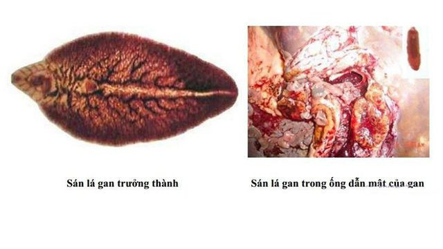 Đầy bụng, buồn nôn, chóng mặt là những biểu hiện triệu chứng của sản lá gan. Nghiện gỏi, coi chừng mắc sán lá gan