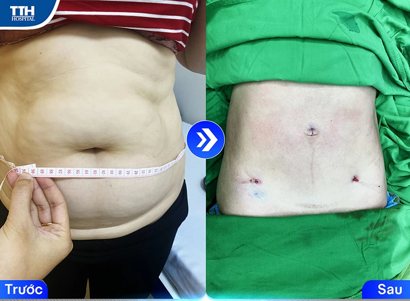 Hút mỡ an toàn với công nghệ Body Jet tại TTH Hà Tĩnh