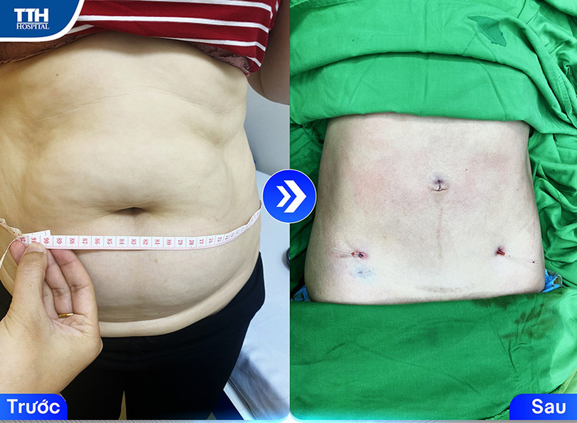 Hút mỡ an toàn với công nghệ Body Jet tại TTH Hà Tĩnh