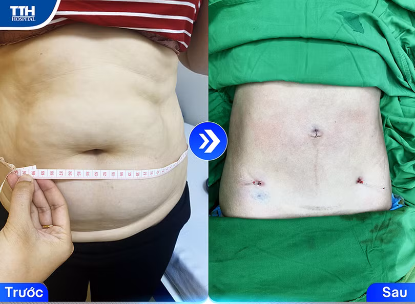 Hút mỡ an toàn với công nghệ Body Jet tại TTH Hà Tĩnh