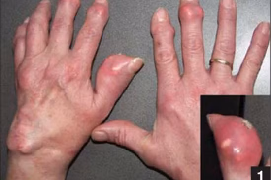 9 nguy cơ dễ làm khởi phát bệnh gút