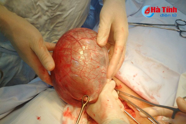 benh vien da khoa thach ha phau thuat cho 2 benh nhan lay ra 2 khoi u bu