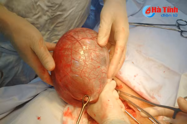 benh vien da khoa thach ha phau thuat cho 2 benh nhan lay ra 2 khoi u bu