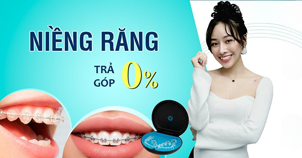 Niềng răng ở đâu và những điều cần biết khi niềng răng
