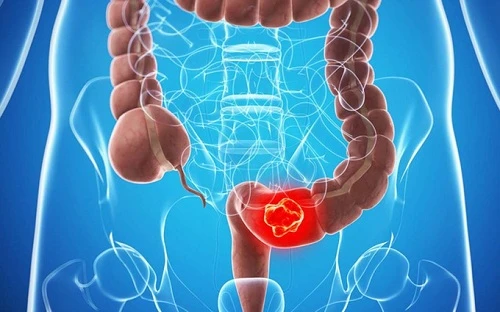 5 vấn đề về sức khỏe tuổi nào cũng có thể mắc, nhưng có thể phòng ngừa