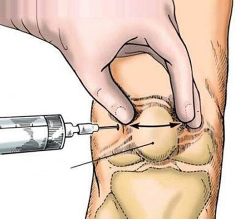 Việc điều trị tràn dịch khớp gối phụ thuộc vào mức độ và giai đoạn của bệnh để có những phương pháp điều trị cụ thể. Ảnh minh họa Tràn dịch khớp gối và những hệ lụy