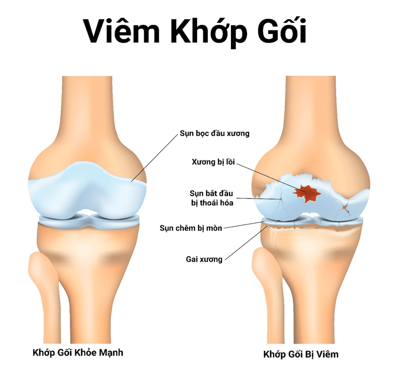 Tràn dịch khớp gối và những hệ lụy