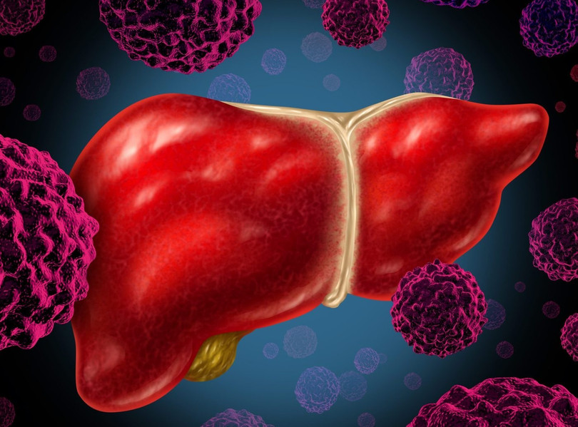 HCC là một trong những loại ung thư gan phổ biến nhất hiện nay. Ảnh: GEN . AI phát triển phương pháp điều trị ung thư chỉ trong 30 ngày