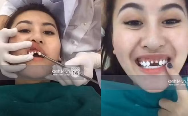 boc rang su de co ham rang dep chung ta phai bo ra bao nhieu tien