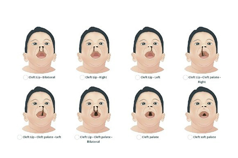 Cơ hội cho trẻ em Hà Tĩnh bị dị tật sứt môi, hở hàm ếch được phẫu thuật miễn phí