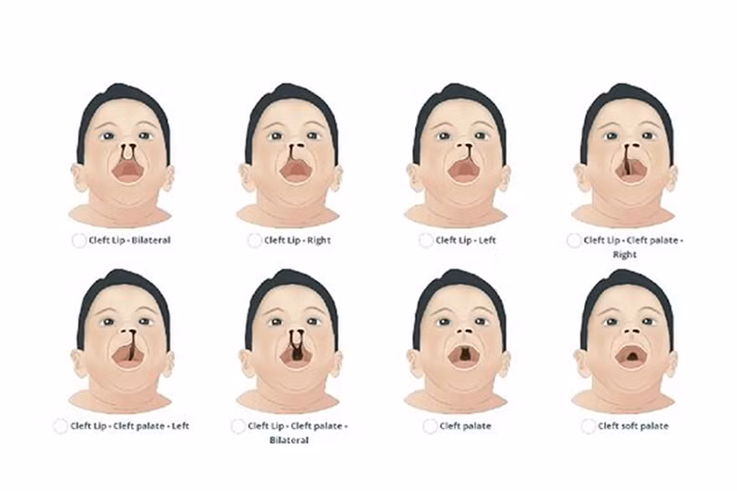 Cơ hội cho trẻ em Hà Tĩnh bị dị tật sứt môi, hở hàm ếch được phẫu thuật miễn phí