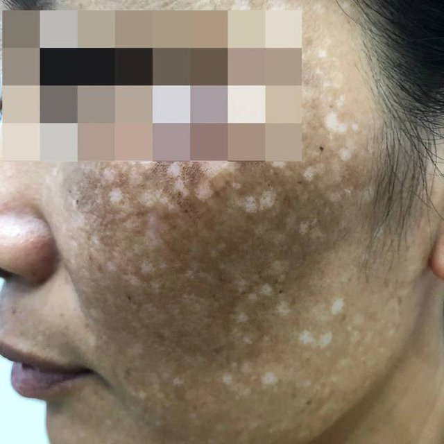 Dùng lá trầu trị nám, nhiều phụ nữ mặt loang lổ sau một đêm