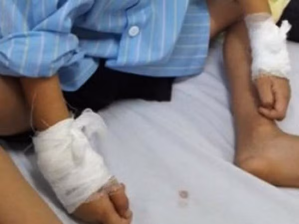 benh nhi nguoi ha tinh gay tay phai bi bac sy mo nham sang tay trai