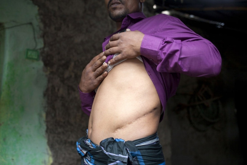 Indonesia phá đường dây buôn bán nội tạng người