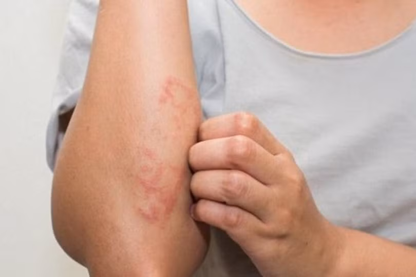 9 bệnh da liễu nguy hiểm ở trẻ