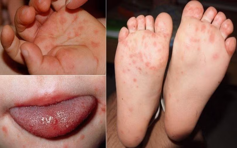 9 bệnh da liễu nguy hiểm ở trẻ