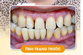 Mất răng vì bệnh nha chu - chi phí và lộ trình điều trị Implant từ đầu đến cuối