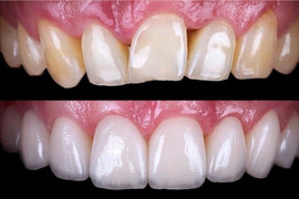 3 lầm tưởng về răng sứ thẩm mỹ khiến người bệnh "tiền mất tật mang"