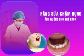 Răng sữa chậm rụng - những ảnh hưởng và cách xử lý