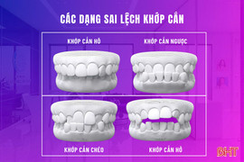 Bị lệch khớp cắn có nguy hiểm không?