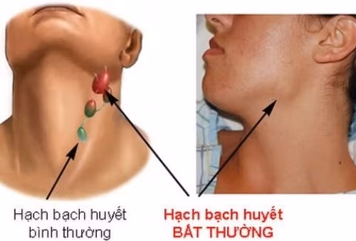 dau hieu nhan biet som ung thu mau