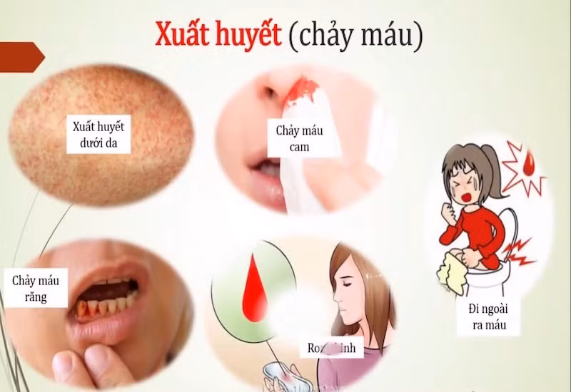 8 lưu ý quan trọng của chuyên gia y tế trong mùa dịch sốt xuất huyết