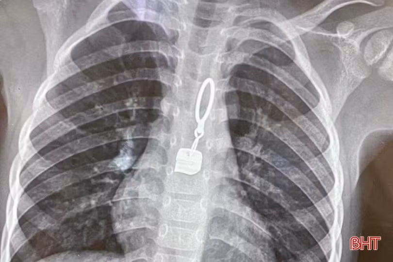 BVĐK tỉnh Hà Tĩnh: Gắp thành công dị vật trong thực quản bệnh nhi 40 tháng tuổi