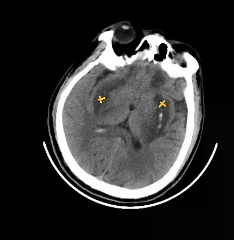 Hình ảnh chụp MRI não bệnh nhân: nhân bèo hai bên não bị hoại tử và chảy máu. Ảnh: BVCC. Hình ảnh chụp MRI não bệnh nhân: nhân bèo hai bên não bị hoại tử và chảy máu. Ảnh: BVCC.