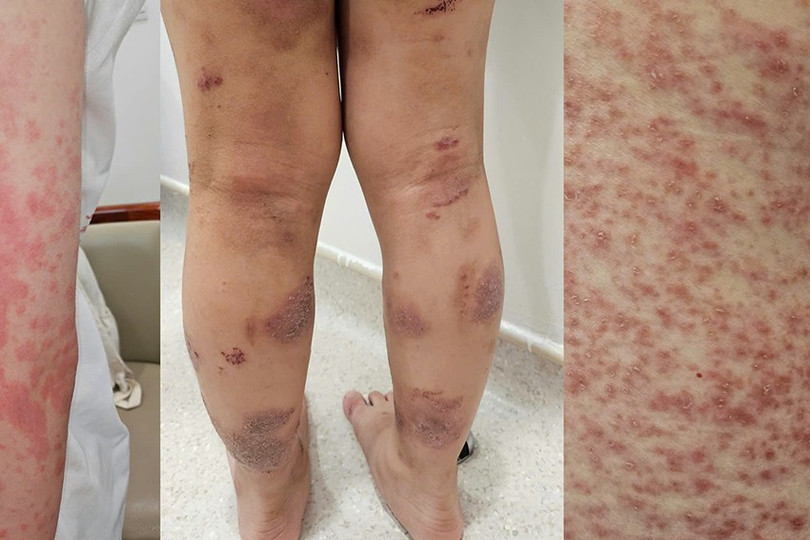 Trường hợp các bệnh liên quan đến dị ứng đến thăm khám tại Vinmec anh-1-4.jpg