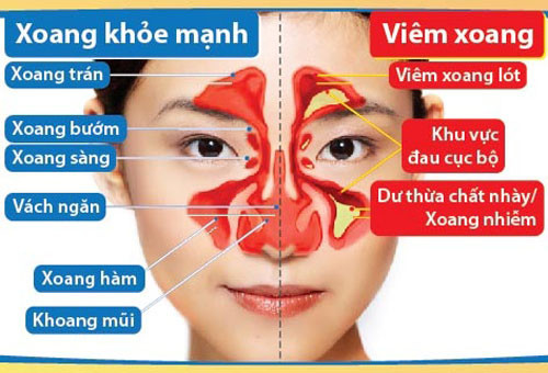 chon thuoc chua viem xoang