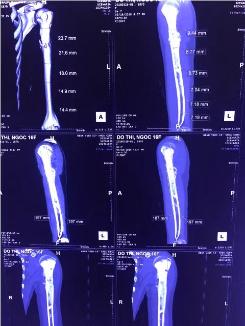lan dau tien phau thuat bao ton canh tay cho benh nhan ung thu xuong nho tuoi