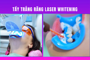 Những ưu điểm vượt trội của công nghệ tẩy trắng răng Laser Whitening