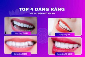 Top 4 dáng răng sứ được ưa chuộng nhất hiện nay 