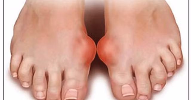 Bệnh gout và giả gout: Vì sao hay nhầm lẫn?