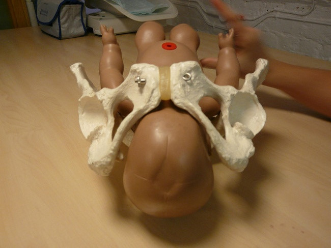 Quan niệm 7: Hông rộng giúp bạn dễ sinh hơn. Hông to hơn phần lớn là do xương chậu - phần lớn và cao nhất của hông. Nhưng trên thực tế, kích thước của xương chậu không liên quan gì đến kích thước của đường dẫn sinh. Yếu tố quyết định ở đây là hình dáng và kích thước của lỗ tròn ở giữa xương chậu. Nó được gọi là đầu vào khung chậu và có thể giống nhau cho dù bạn có hông rất lớn hay rất nhỏ. 8 quan niem sai lam khi mang thai nhieu nguoi van tin