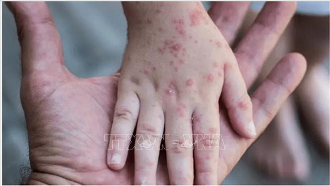WHO chưa coi đậu mùa khỉ là tình trạng khẩn cấp y tế toàn cầu