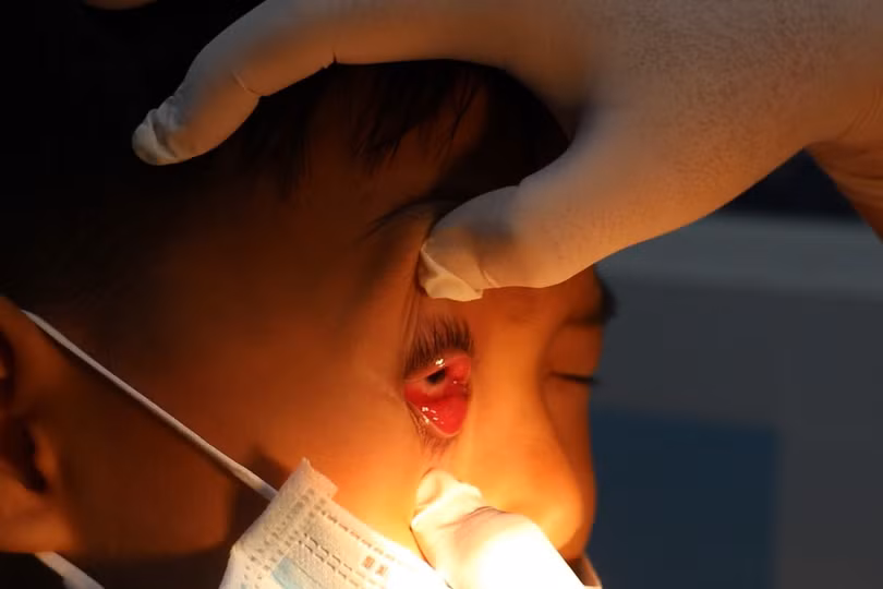 Nhìn người đau mắt đỏ có bị lây không?