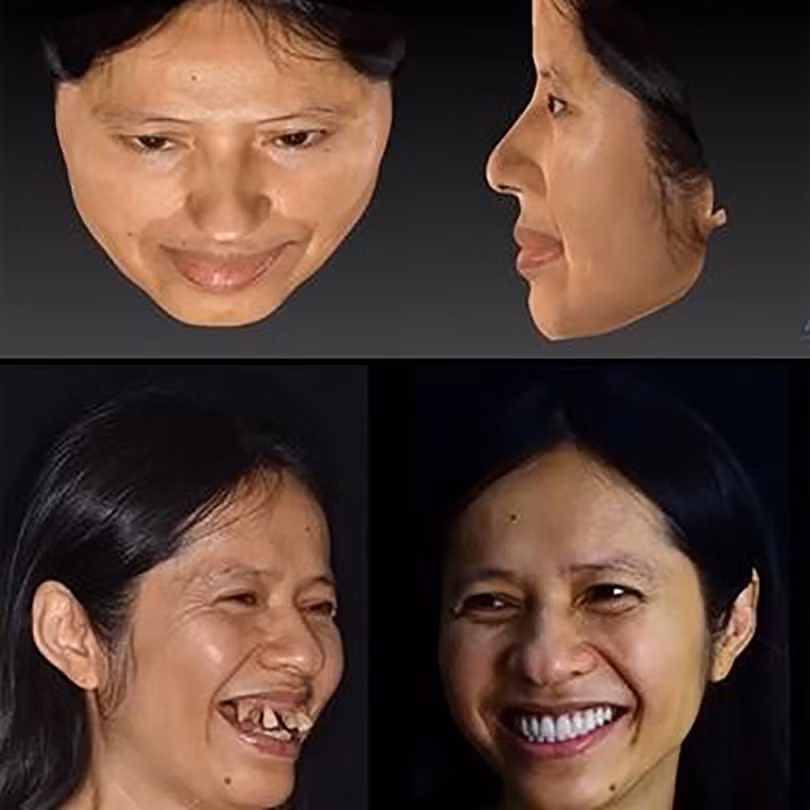 Implant Việt Nam 4.jpg