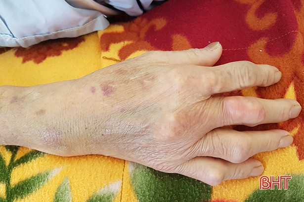 Bệnh gout và những biến chứng nguy hiểm cho xương khớp và thận