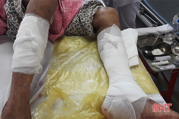 Cấp cứu cụ ông 93 tuổi bị chó nhà cắn nát chân