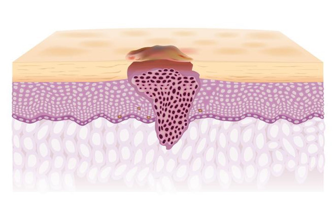 Dấu hiệu bất thường trên cơ thể cảnh báo sức khỏe có vấn đề ảnh 6 Dấu hiệu bất thường trên cơ thể cảnh báo sức khỏe có vấn đề