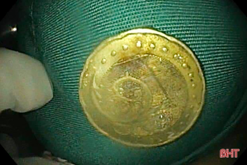 Gắp đồng xu trong thực quản bé gái 60 tháng tuổi ở Hà Tĩnh