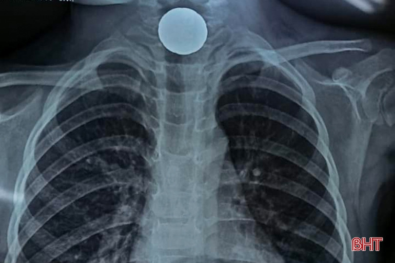 Gắp đồng xu trong thực quản bé gái 60 tháng tuổi ở Hà Tĩnh