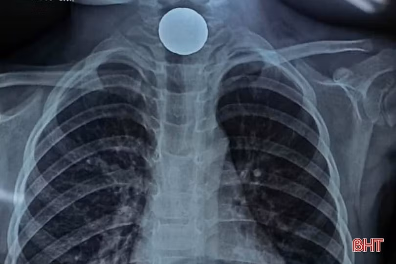 Gắp đồng xu trong thực quản bé gái 60 tháng tuổi ở Hà Tĩnh