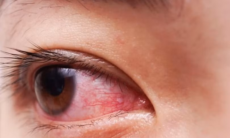 Bệnh đau mắt đỏ lây lan cả nước