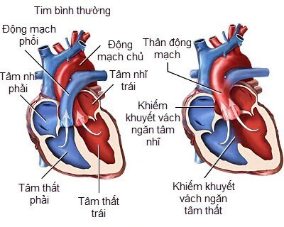 COVID-19 thể nặng đe dọa người mắc bệnh tim bẩm sinh ra sao?