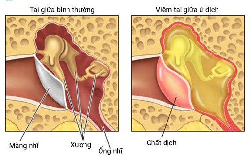 Viêm tai ứ dịch - nguyên nhân khiến trẻ chậm phát triển ngôn ngữ