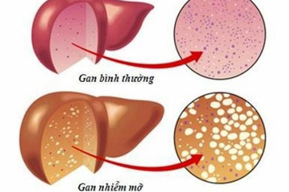 Hiểu đúng về gan nhiễm mỡ