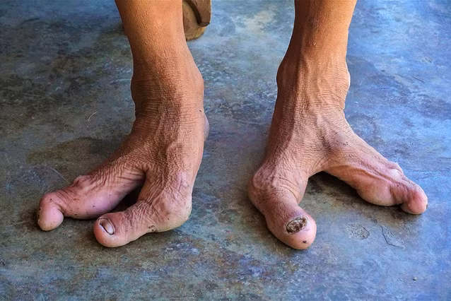 Gia đình kỳ lạ: 13 người có bàn chân chỉ 2 hoặc 3 ngón
