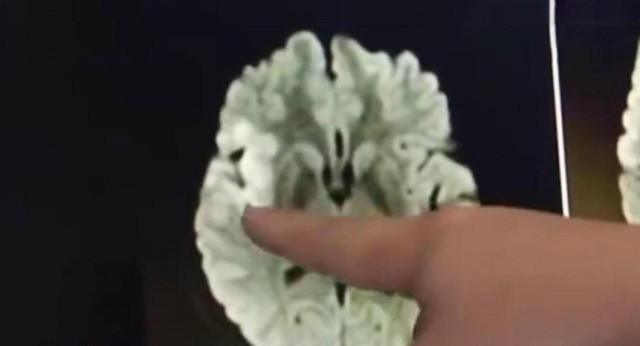 om dien thoai suot 20 gio lien mot nguoi phu nu bi tac mach mau nao